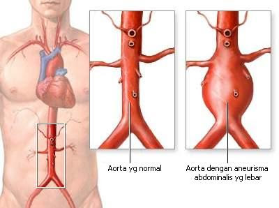 Aneurisma Aorta Abdominalis