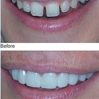 snap on smile cost snap on smile cost