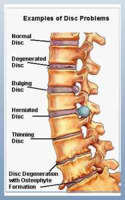 FIREBERT: Hernia, nucleus pulposus - HNP, discopathy and what to do...