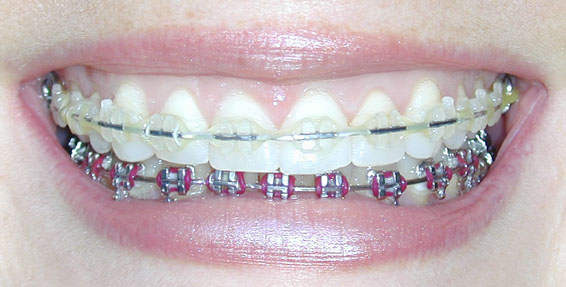 tattoo Before and After Before Before And After Pics Of Braces. tattoo Before and After Before