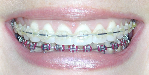 Before And After Pics Of Braces. tattoo Before and After Before