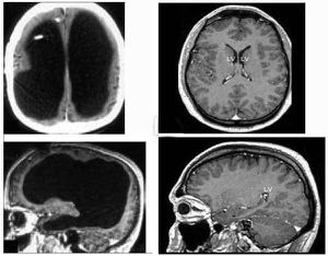 Ct+scan+brain+normal