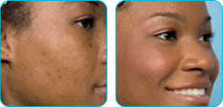 Cure Acne Naturally