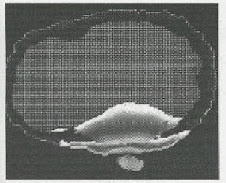 Efectos de la prenetración de las radiaciones electromagnéticas en distintos cerebros