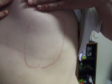 Kenny's burn mark on his side!