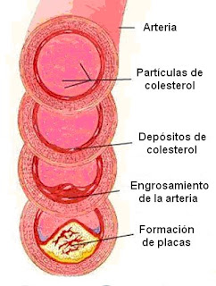 Formación del ateroma