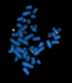 A metaphase cell positive for the bcr/abl rearrangement using FISH. The chromosomes can be seen in blue. The chromosome that is labeled with green and red spots (up left) is the one where the wrong rearrangement is present