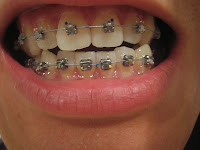 Damon braces Day 1b