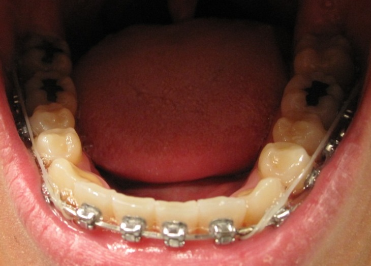 My Journey with the Damon Braces Week 70 with the Damon Braces