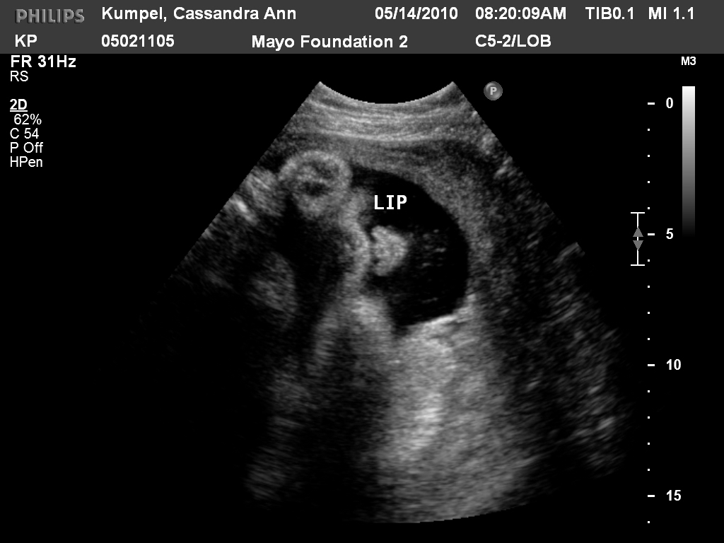 Kumpel Family 36 week ultrasound