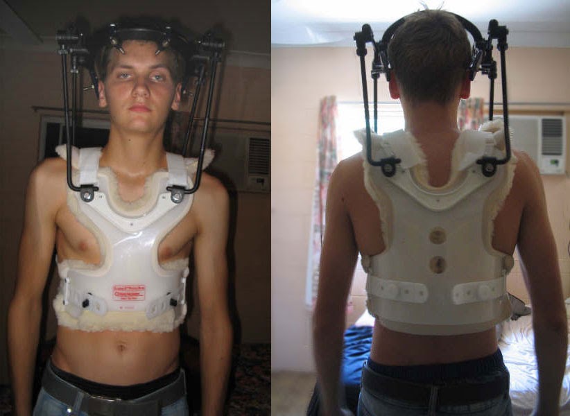 Aden's Halo Brace Blog The story so far...