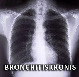 bronkitis kronik