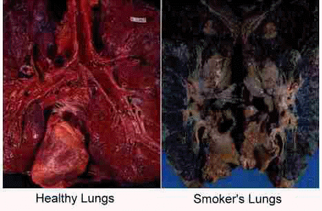 cartoon smoking lungs. before and after smoking lungs