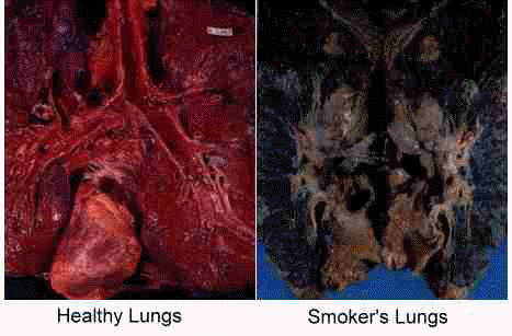 Photos of a smokers lungs Photos of a smokers lungs