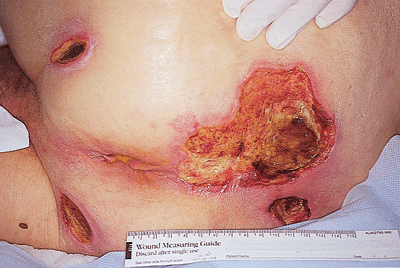 Genital Bacteria Tear the Flesh of the Rotten Vagina - Dextromethorphan Genital Bacteria Tear the Flesh of the Rotten Vagina - Dextromethorphan