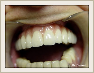 Implantes dentales en Madrid dr. Estévez