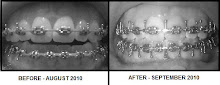 Bite - Before Vs. After