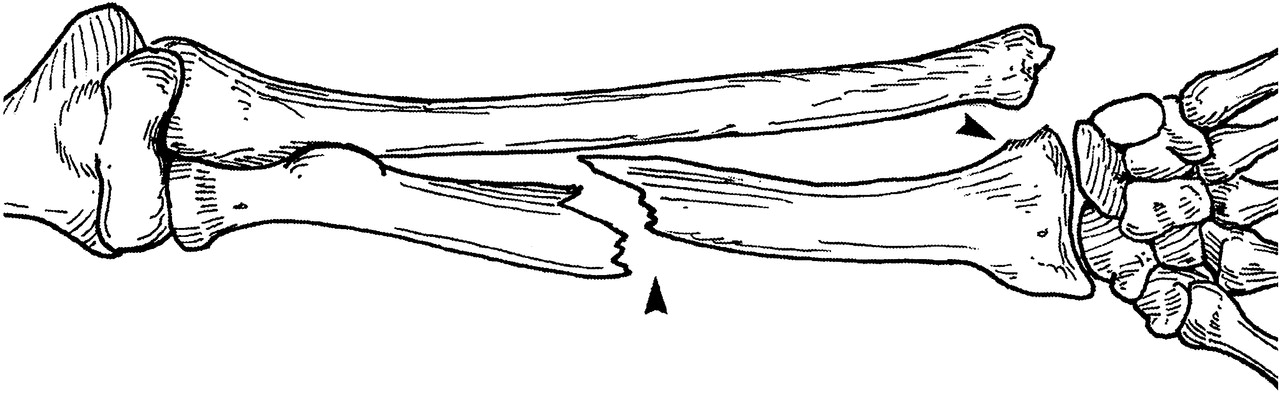 骨科-- common fractures of upper limb - Tachyon, my Mind ...