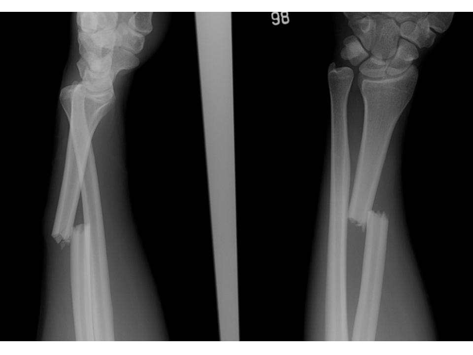 x ray forearm