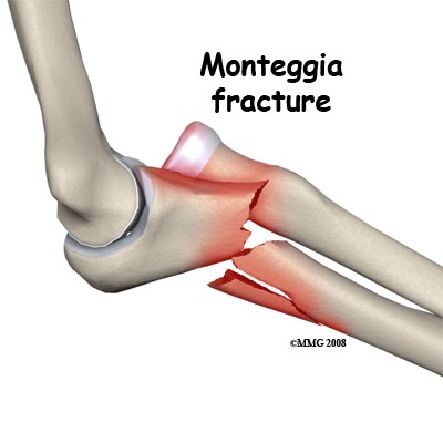 Fracture+displacement