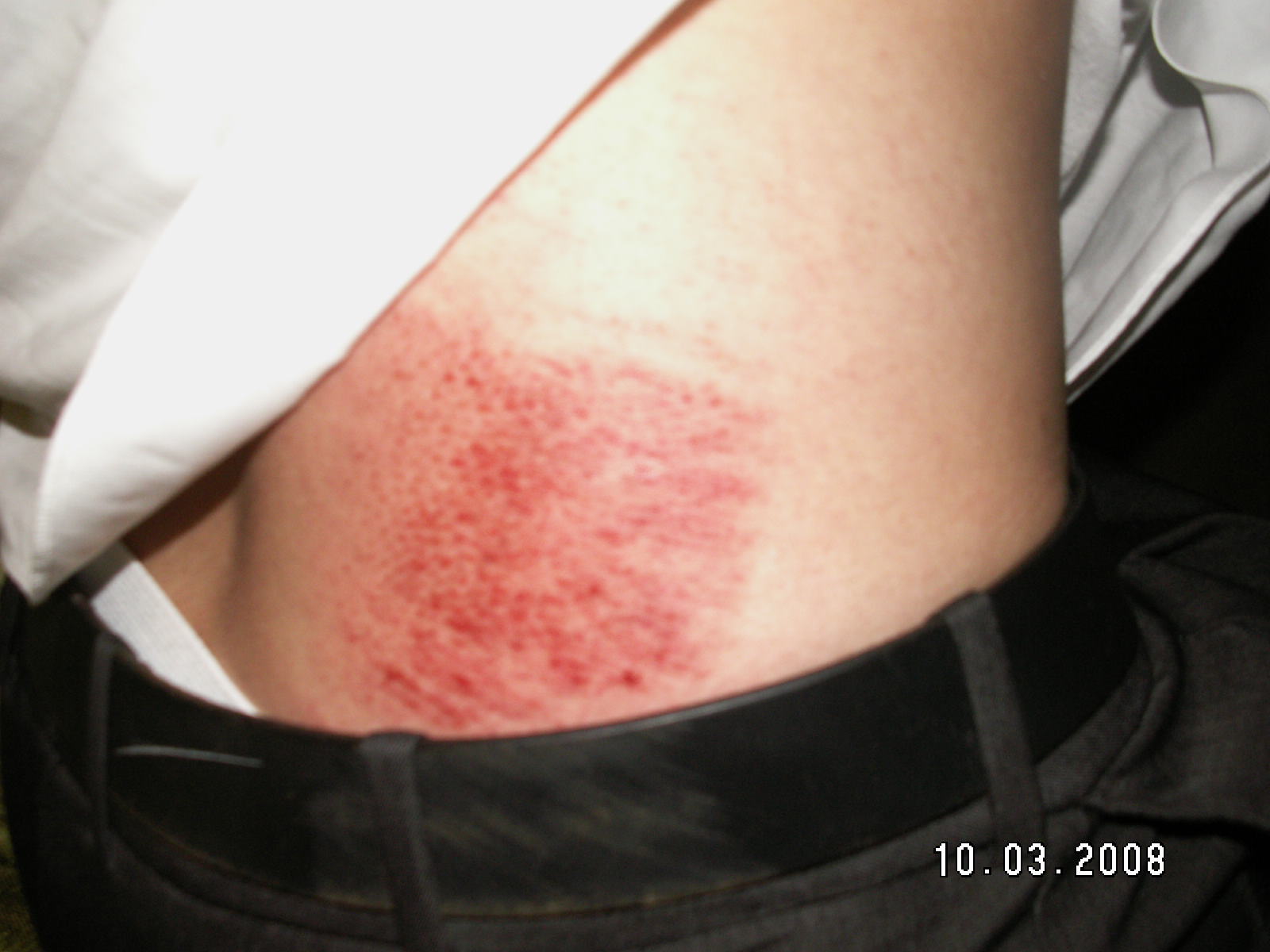 Some road rash from the wreck