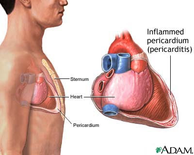 heart attack diagram. heart attack diagram. after a