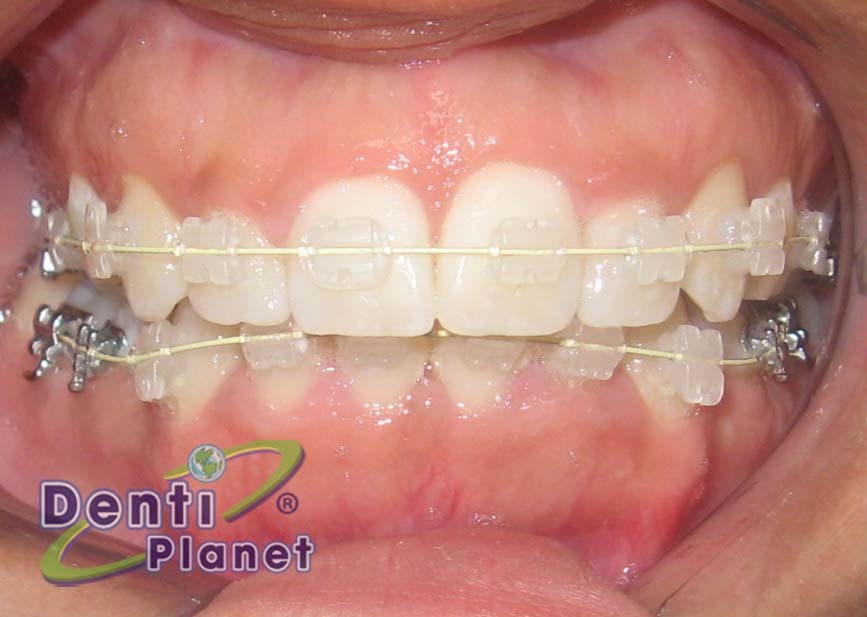Blog Ortodoncia ¿Los brackets transparentes se manchan?