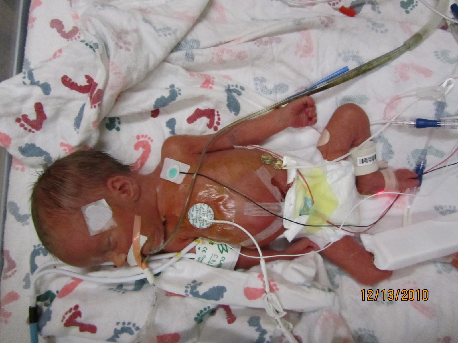 Jacob's Page 5 days old Primary Closure surgery today and Broviac