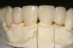 PUENTE EN CERAMICA DENTAL