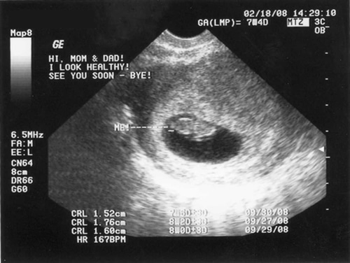whats a sonogram