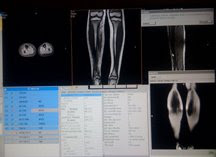 MRI pictures of my leg