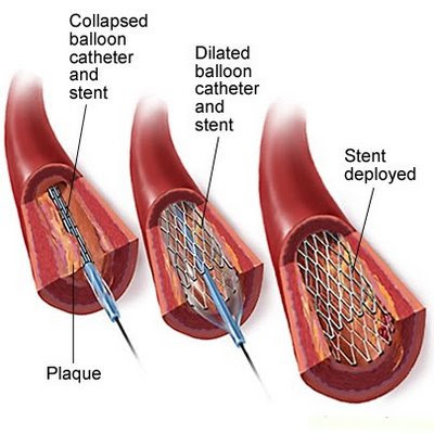 QUIZ HISTOLOGIA RESPUESTA DE LAS PREGUNTAS Stent+V1150