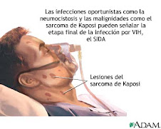 Sarcoma de kaposi