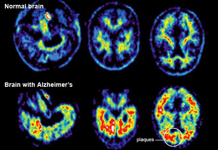 Why is it necessary to PET scan the whole body in cancer patients?