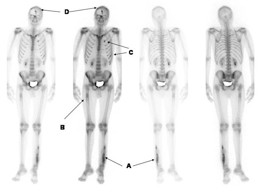 Nuclear Medicine Technology Collaboration Project Bone Scan (TC99mMDP