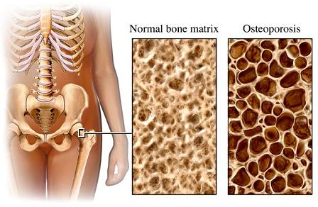 Hip Osteoporosis