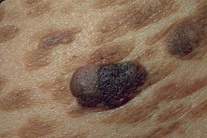 Nolvadex gyno Nolvadex gyno