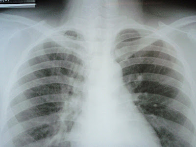 apical fibrosis