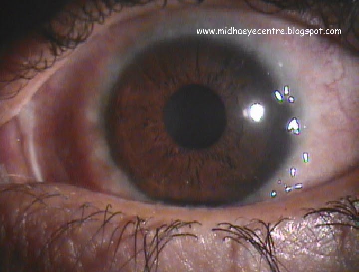 Take Care Of Your Eyes Vernal Keratoconjunctivitis
