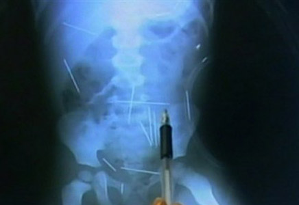 Raio-x mostra agulhas dentro do corpo do menino Raio-x mostra agulhas dentro do corpo do menino