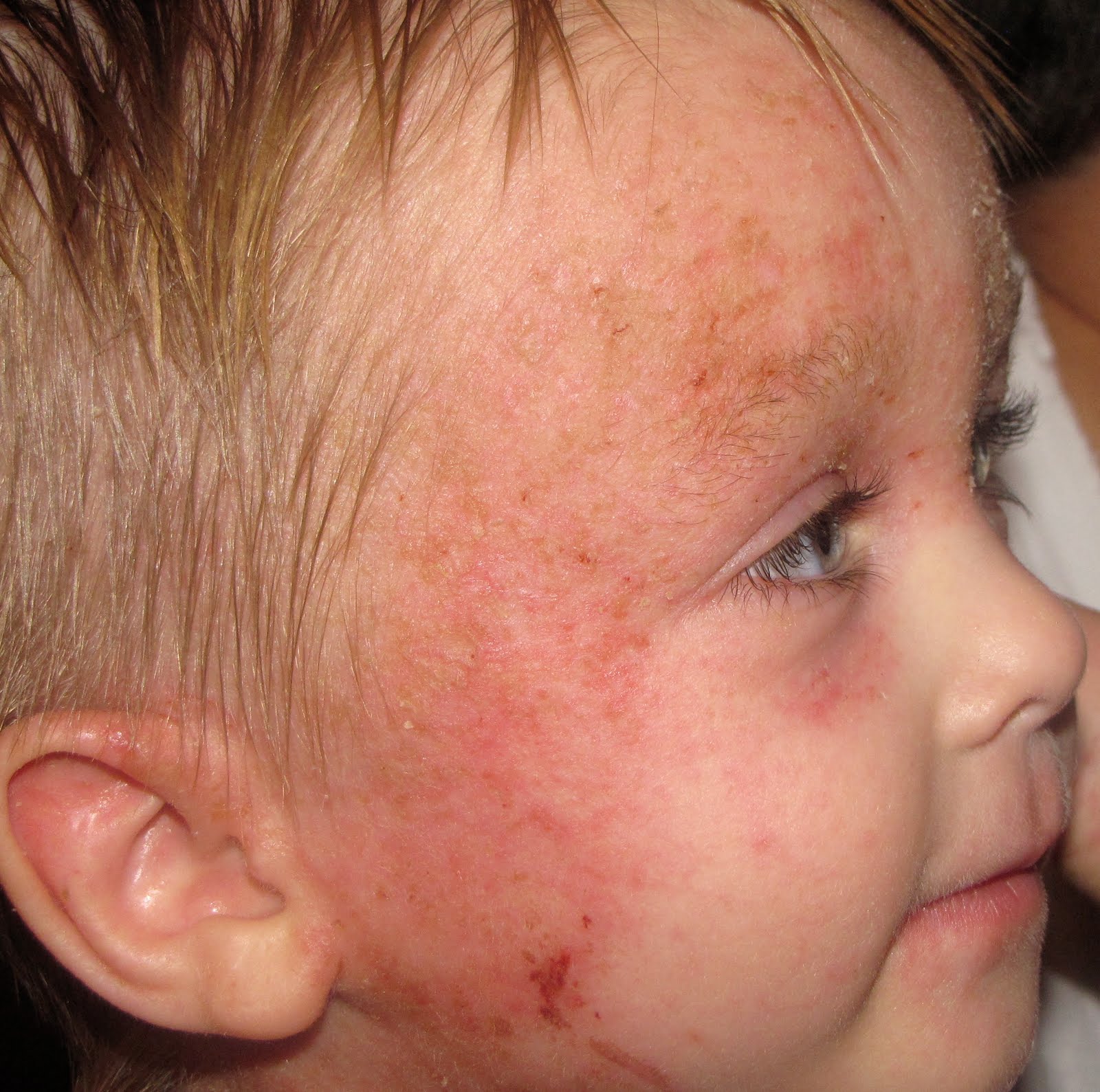 Albums 105+ Pictures Pictures Of Weeping Skin Latest