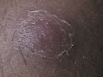 Anthrax sore healing