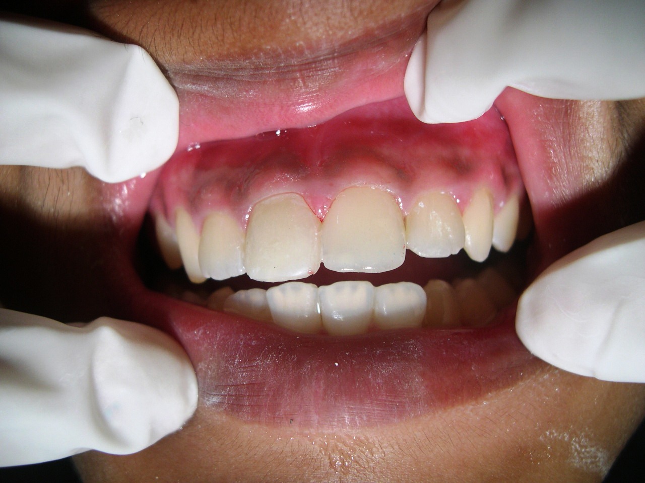 true smile dental clinic Restoration of Fractured Anterior Teeth
