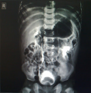 radiography in ureterocele The language of radiology is rich with descriptions of imaging findings, often metaphorical resenting a ureterocele, which is associated with the ectopic. radiography in ureterocele The language of radiology is rich with descriptions of imaging findings, often metaphorical resenting a ureterocele, which is associated with the ectopic.