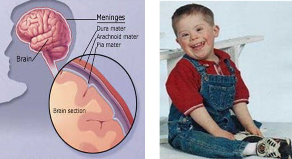 Mas tresno3 Retardasi Mental