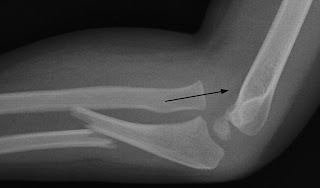 surgery for monteggia fracture surgery for monteggia fracture
