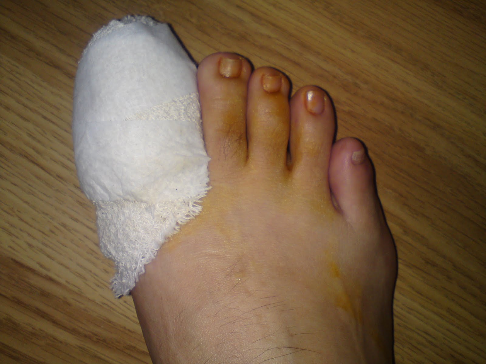 Special Love, Joy & Passion! Day 12 of Hols Nail Avulsion