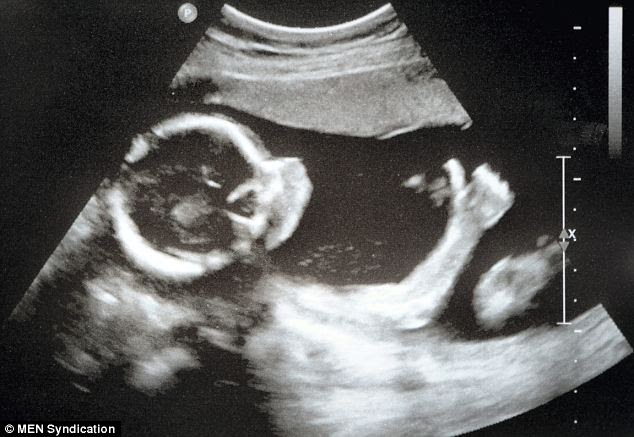 24 week hd ultrasound
