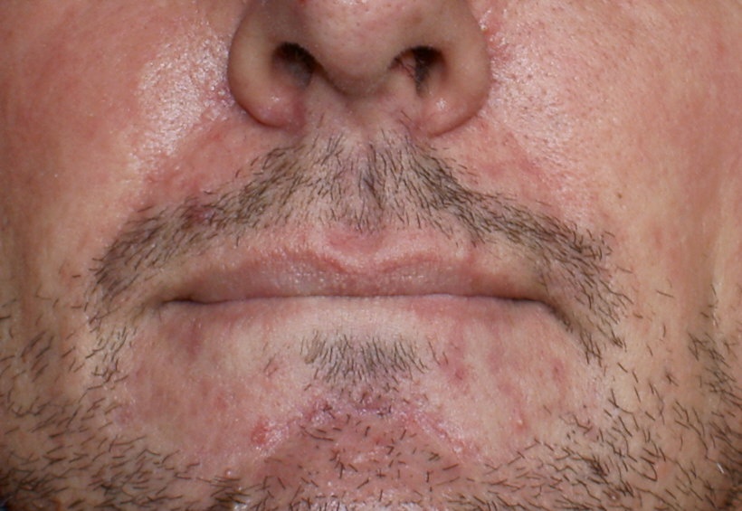 I pori di faccia sono fortemente martellati