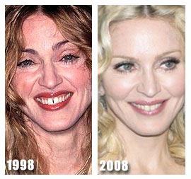  Plastic Surgery    on Plastic Surgery Before And After  Madonna Plastic Surgery